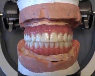 The completed prosthesis which has been designed according to the digital design that was created in the AvaDent Viewer.