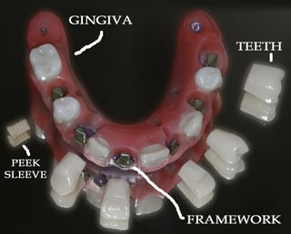 The completed prosthesis which has been designed according to the digital design that was created in the AvaDent Viewer.