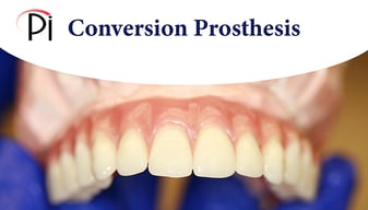 Conversion Prosthesis used in Teeth In A Day<sup>®</sup> dental implant treatment