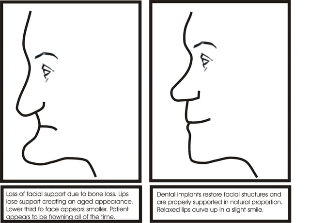 Illustration of facial collapse due to bone loss and restoration of facial proportion following dental implant treatment Illustration of facial collapse due to bone loss and restoration of facial proportion following dental implant treatment