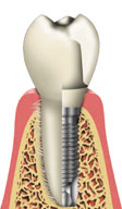 Illustration of the similarities between a natural tooth and a dental implant Illustration of the similarities between a natural tooth and a dental implant