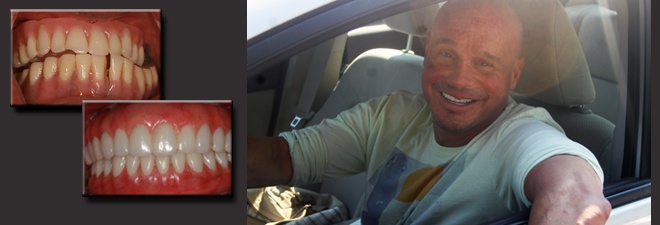 AvaDent Digital Dentures for a durable lasting smile