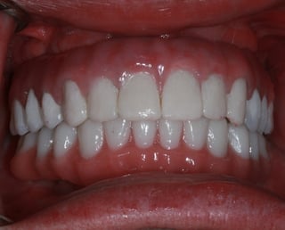 ken-final-prosthesis-closeup.jpg