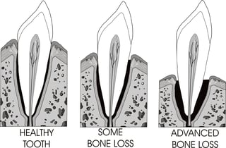 Can this tooth be saved? Illustration of healthy tooth, tooth with some bone loss, tooth with advanced bone loss